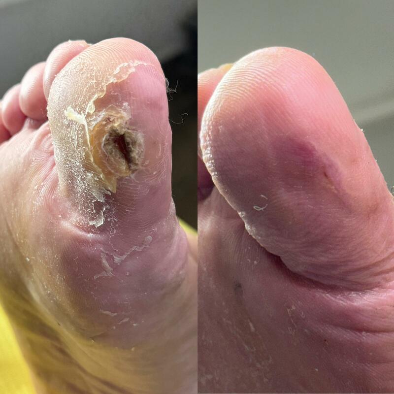 Curățare calus și bătături – pedichiură complexă Timișoara