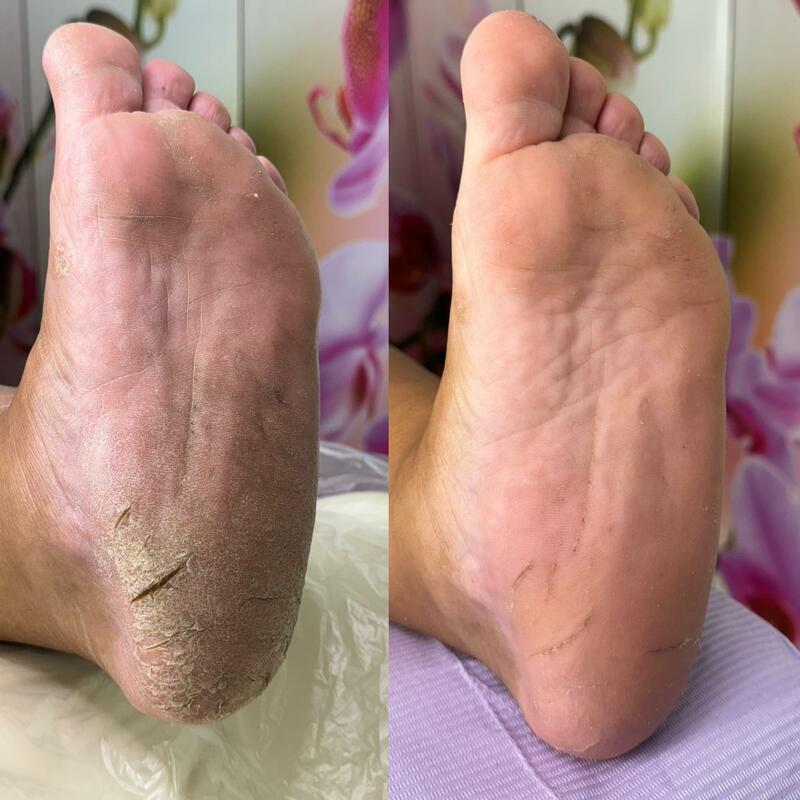 Tratament psoriazis plantar – curățare profesională tălpi