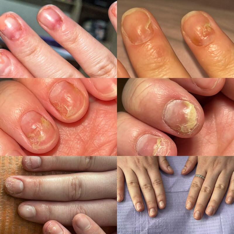 Tratament micoză unghială – igienizare unghii micotice Timișoara