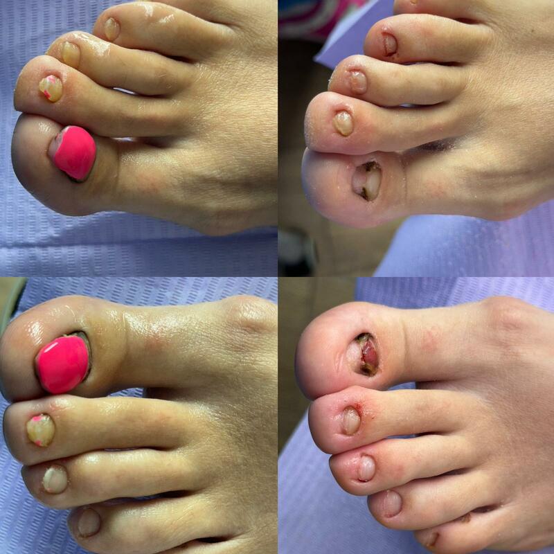 Pedichiură medicală – îngrijirea unghiilor și tălpilor, Podo360