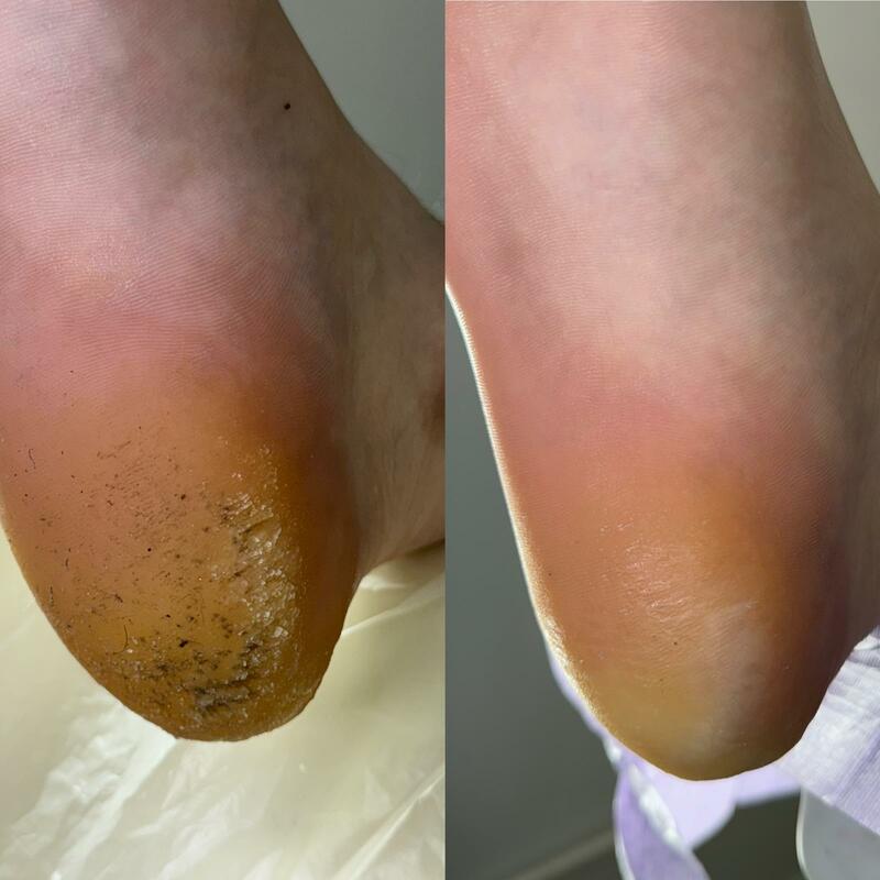 Curățare hiperkeratoză talpă – înainte și după tratament podologic