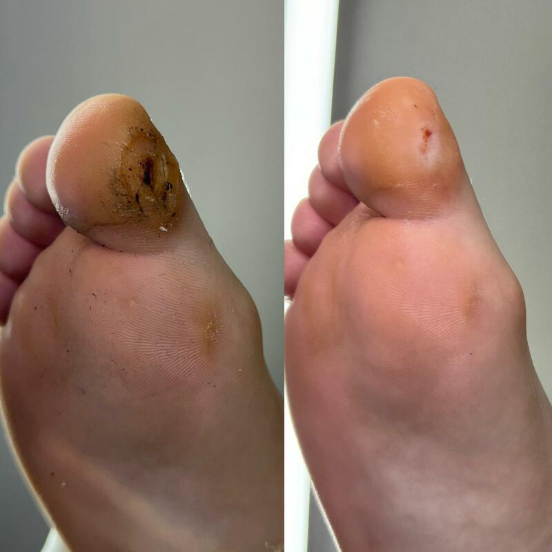 Curățare calus și bătături – pedichiură complexă Timișoara
