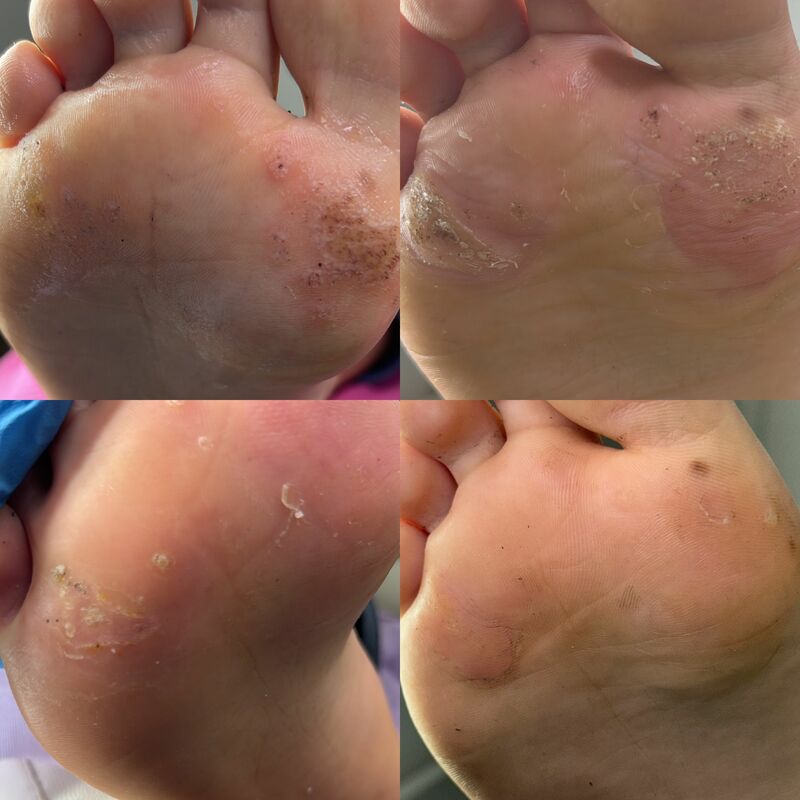 Îndepărtare verucă plantară – tratament podologic Timișoara
