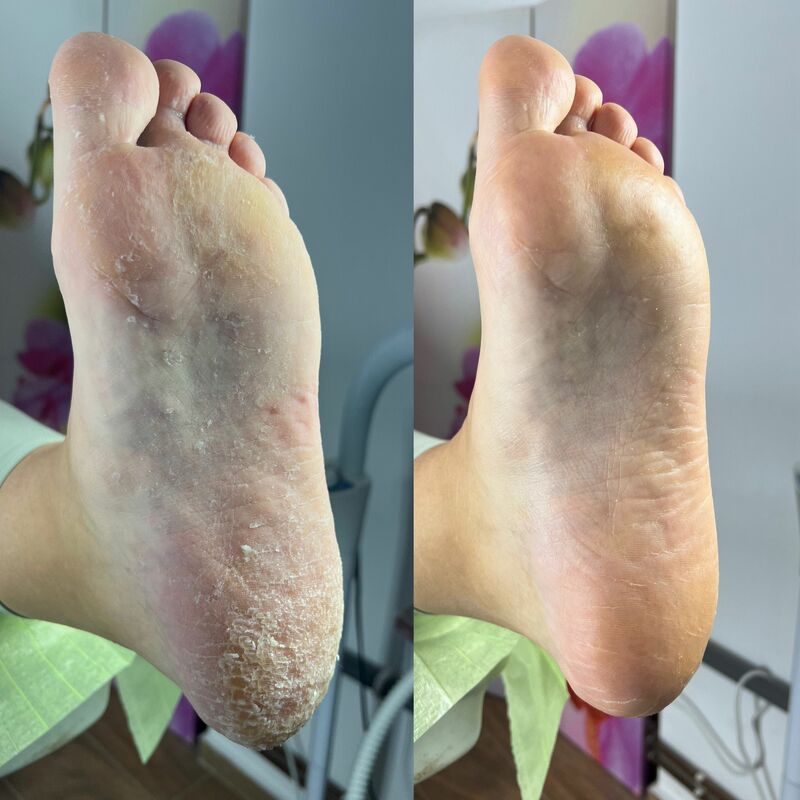 Tratament psoriazis plantar – curățare profesională tălpi