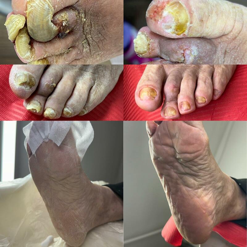 Pedichiură complexă înainte și după – cabinet podologie Podo360 Timișoara